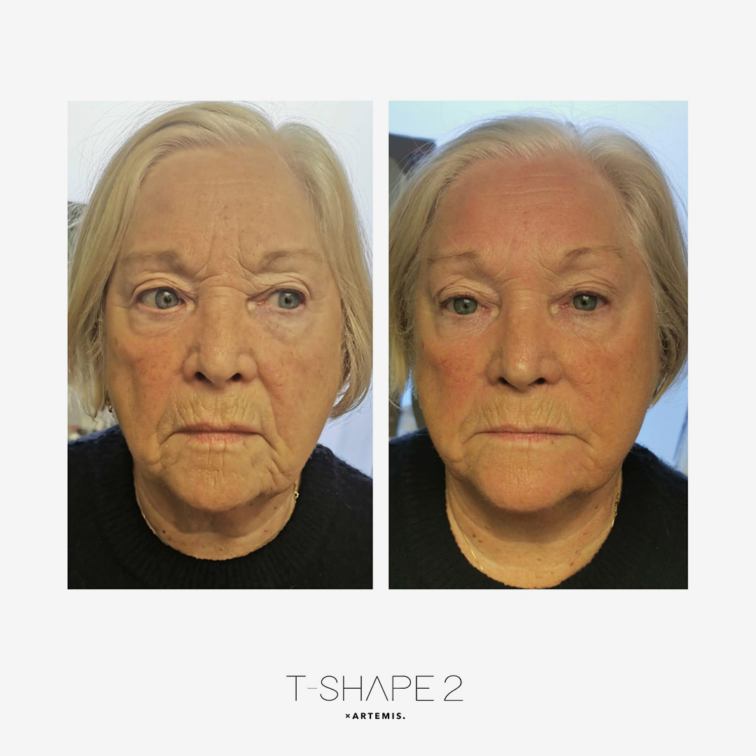 T-Shape face wrinkle reduction before and after