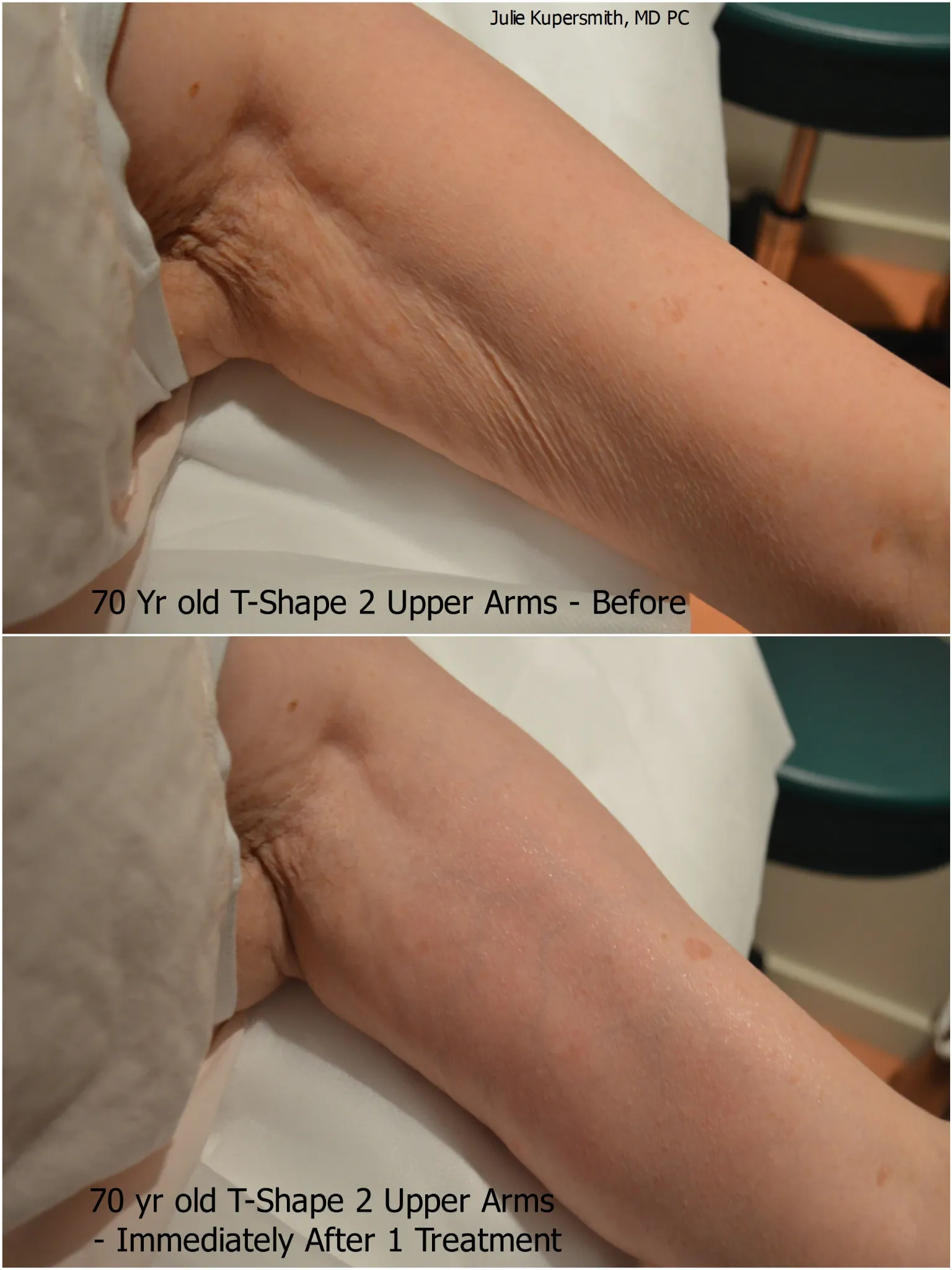 Upper arm firming before and after